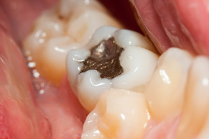 zahnarzt-hinterschmiding-vorreiter-leistungen-amalgam-amalgamsanierung